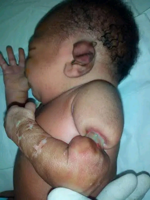 Do you know about Amniotic Band Syndrome (ABS)? Do you know about Amniotic Band Syndrome (ABS)?